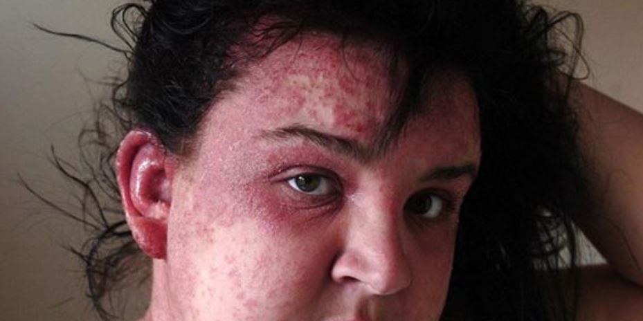 Allergic reaction to hair dye