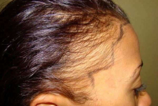 Receding hairline in women causes