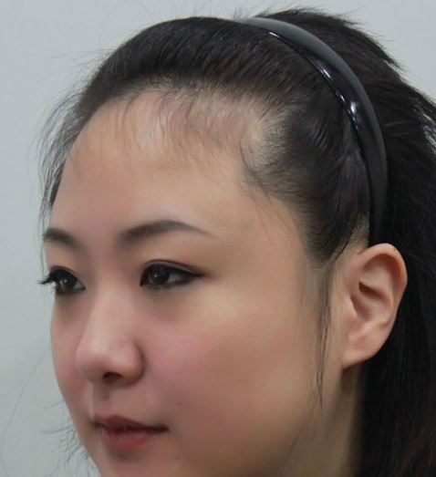 Short Hairs Hairline Female | hairstyles for receding hairline at temples female Short Hairs Hairline Female | hairstyles for receding hairline at temples female