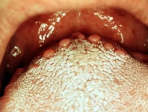 Red Bumps On Tongue And Throat | bumps on back of tongue white red big sides sore Red Bumps On Tongue And Throat | bumps on back of tongue white red big sides sore