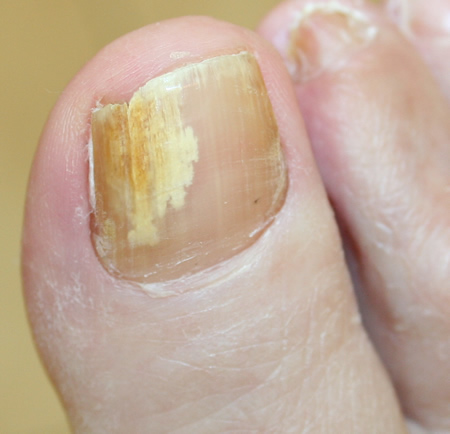 yellow cracked toenails