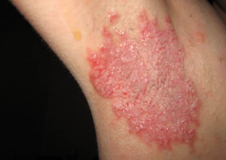 Red rash under armpit
